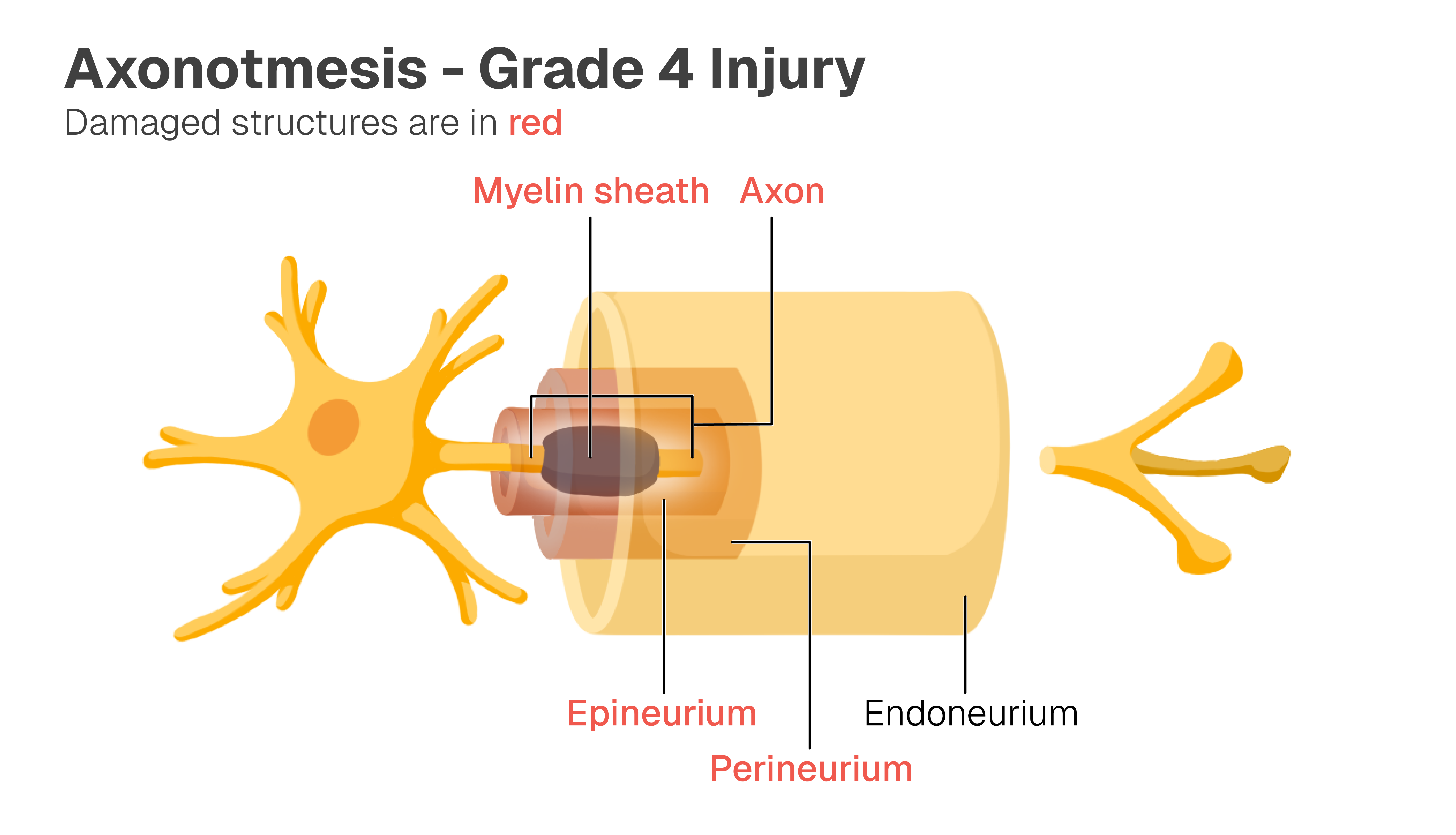 Image of normal neuron with the myelin sheath, axon, epineurium, perineurium, and endoneurium labelled. The myelin sheath, axon, epineurium, and perineurium are damaged.